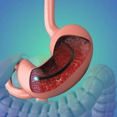 Endoscopy at Samridhi Hospital